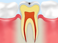 歯の表面が白く濁る（C0）