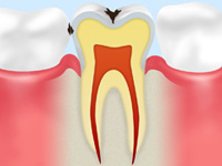歯が黒ずむ（C1）